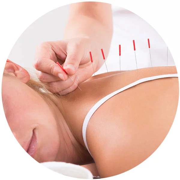 Acupuncture