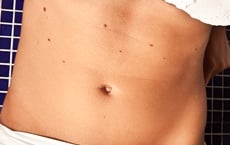 marques et taches de naissance abdomen