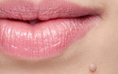 marques et taches de naissance bouche