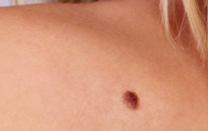 marques et taches de naissance epaule