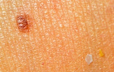 marques et taches de naissance genou