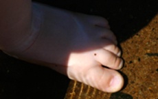 marques et taches de naissance pied