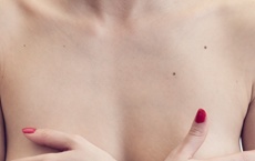 marques et taches de naissance poitrine